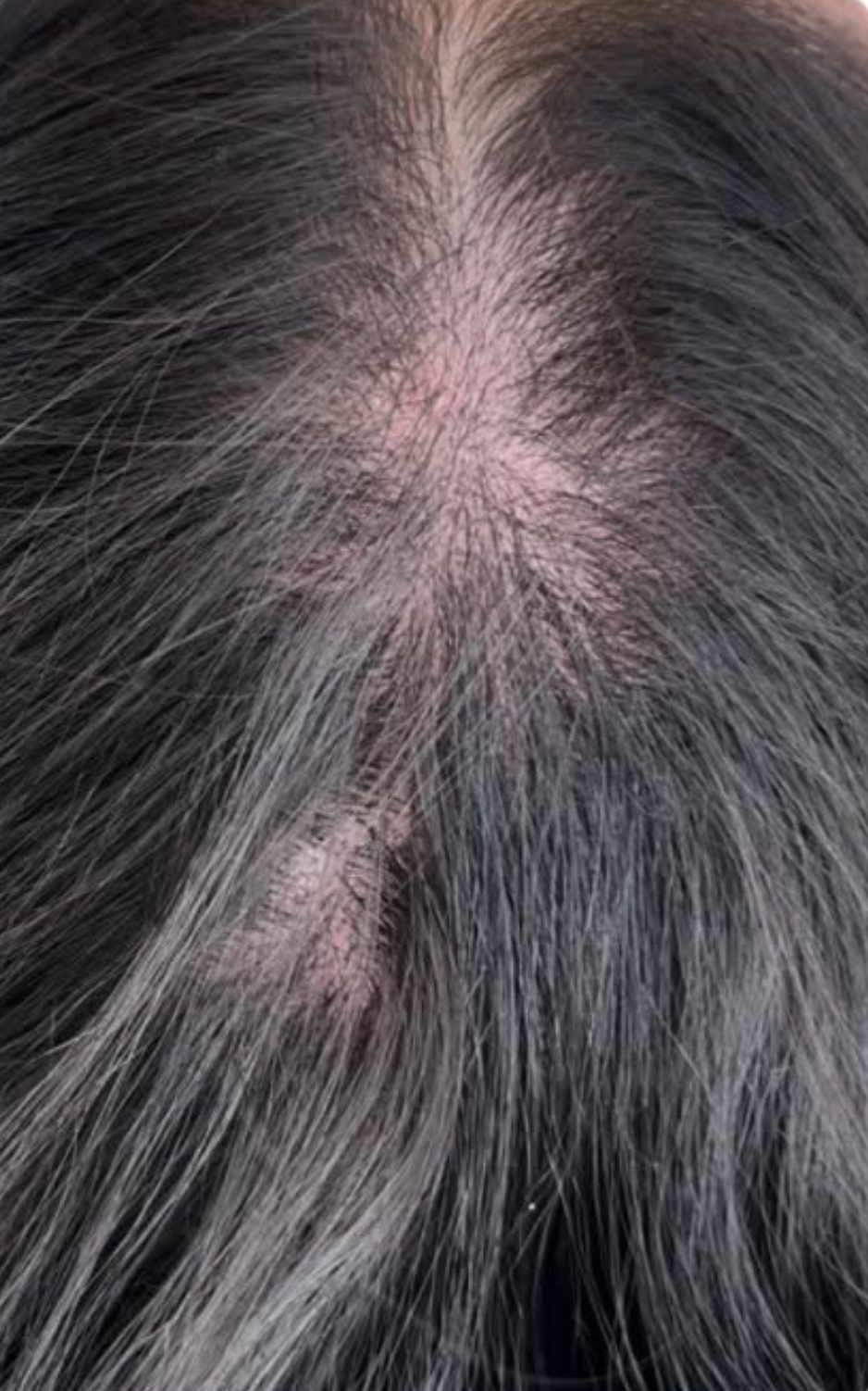 TE hair loss before treatment - 4 months