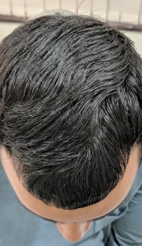 Telogen effluvium after 12 weeks of recovery system use