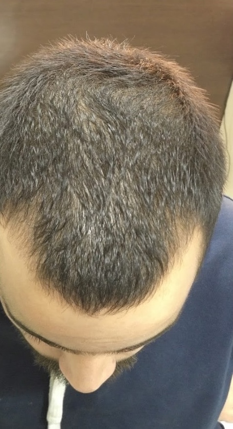 Telogen effluvium before treatment - hair shedding at 12 weeks