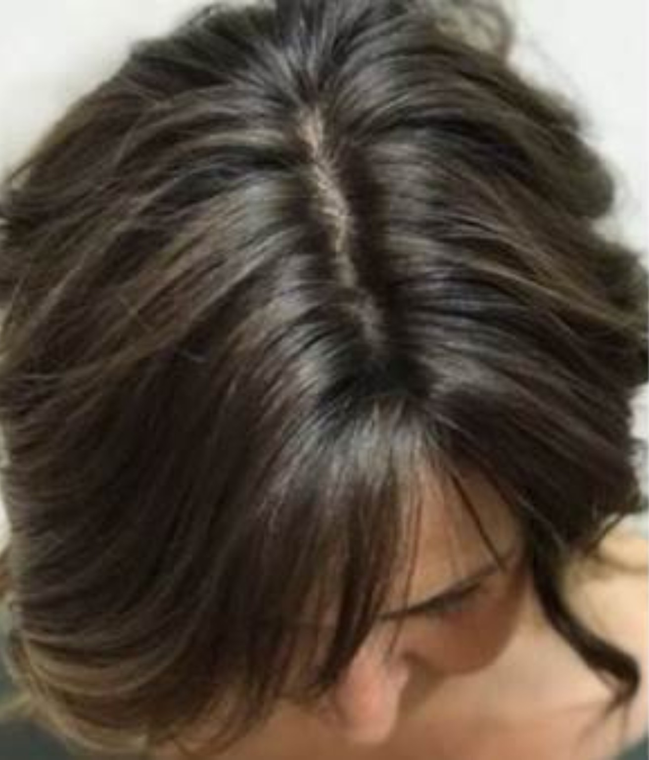 Postpartum hair loss recovery after 5 months