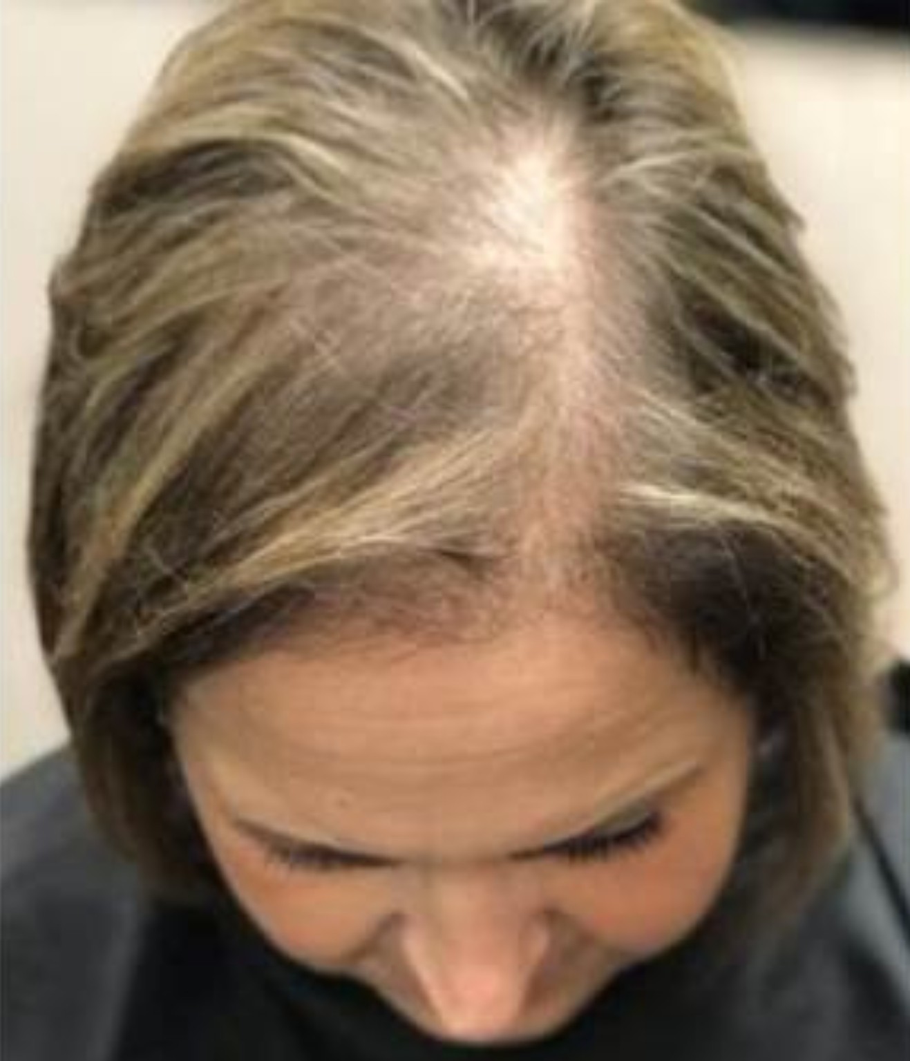 Postpartum telogen effluvium before recovery