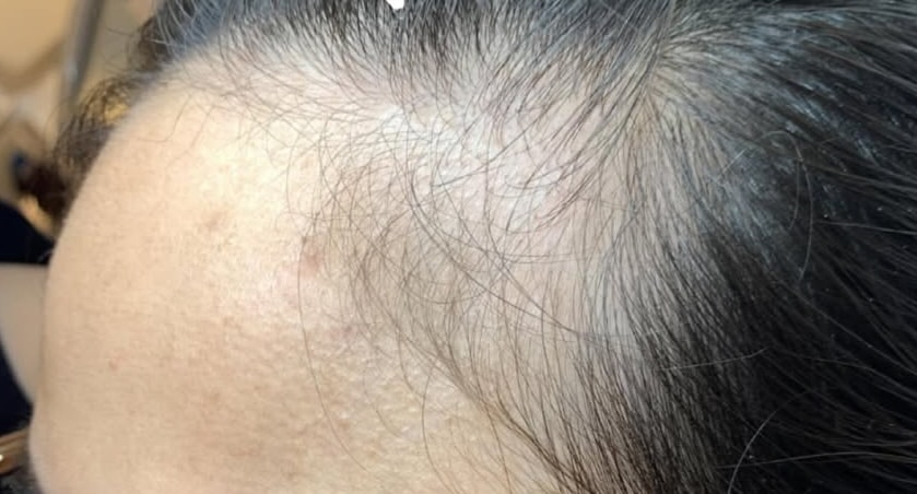 Telogen effluvium before treatment - 3 months