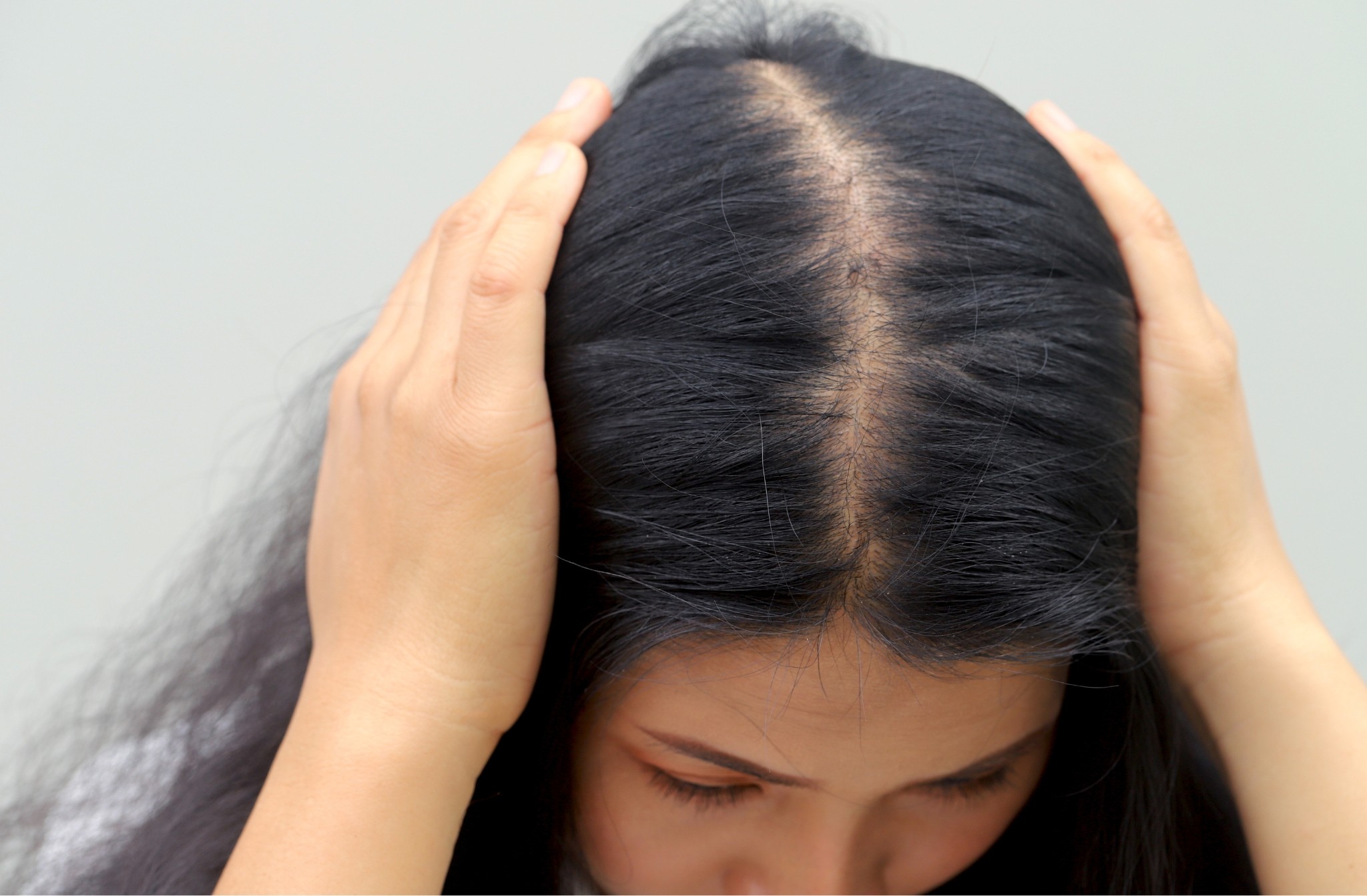 telogen effluvium causes