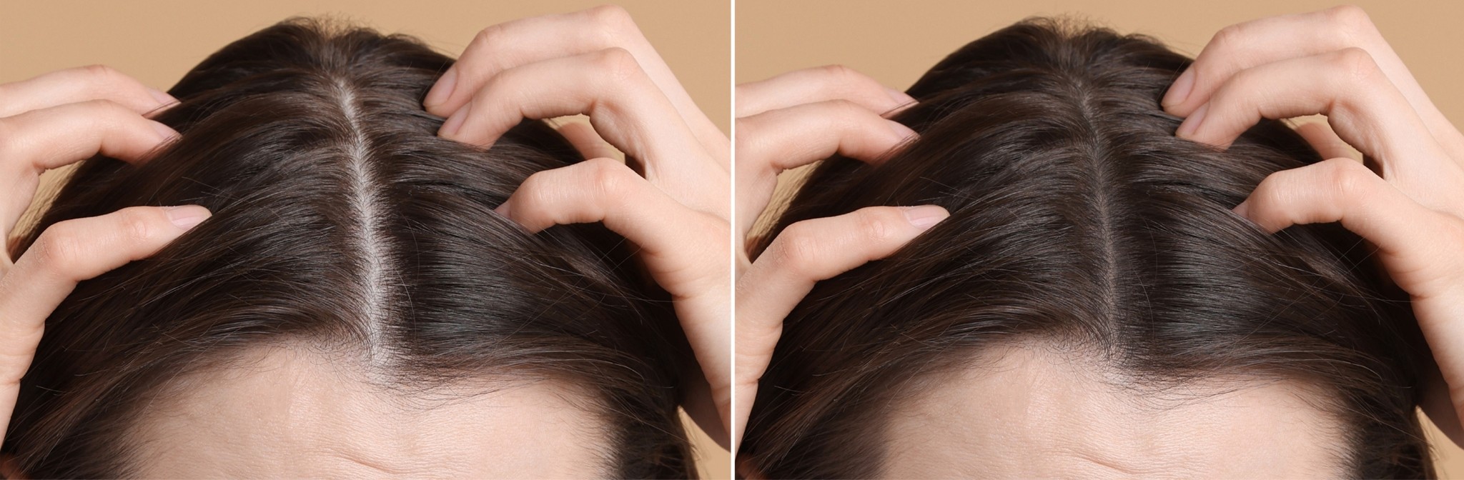 telogen effluvium treatment